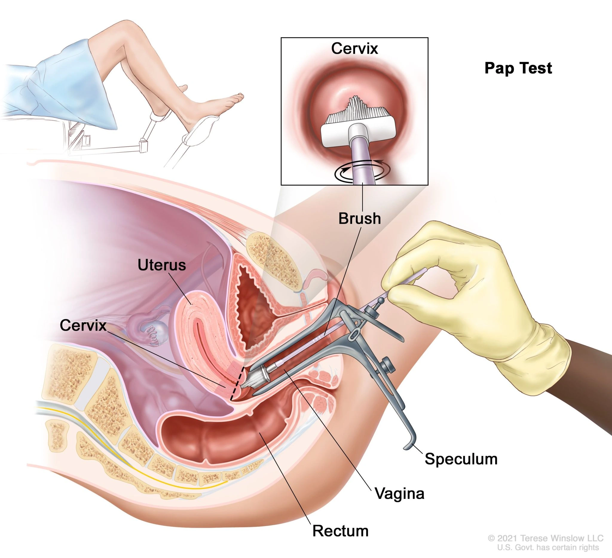 Diagram of cervix during Pap test